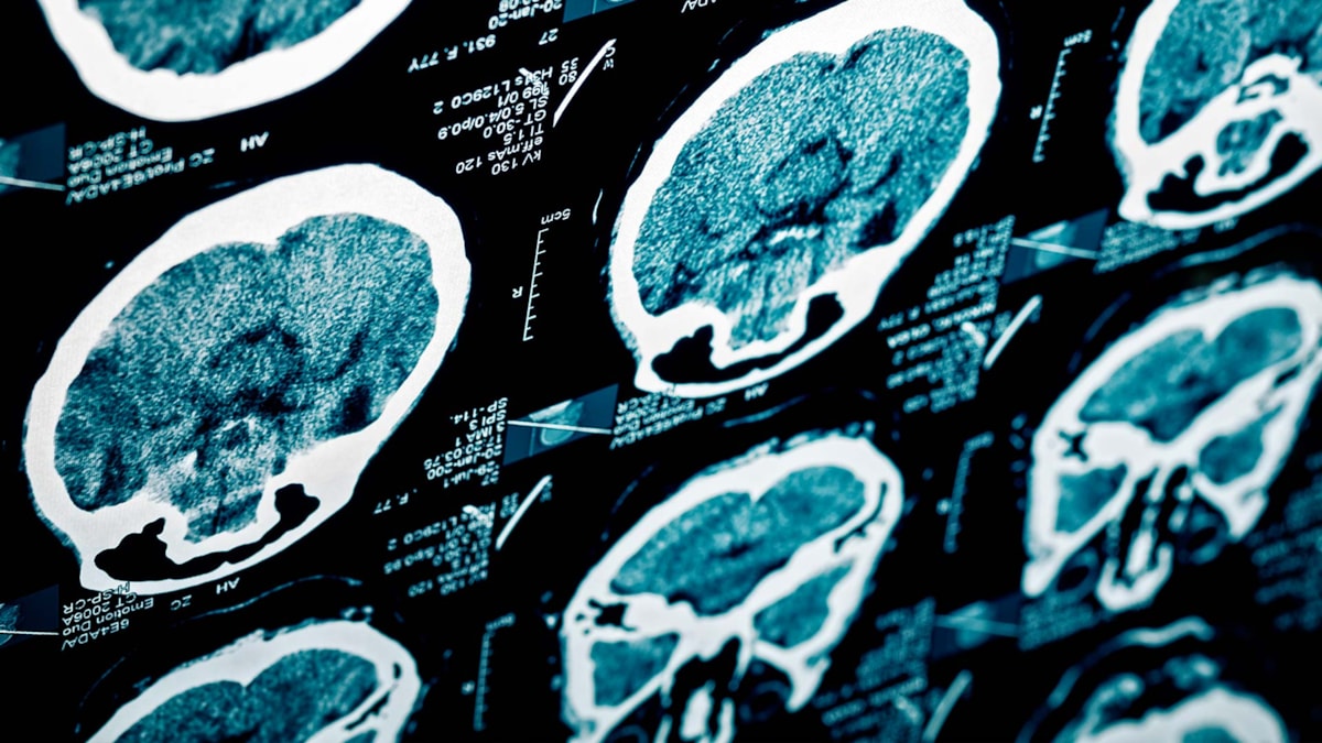 CT-bilde av hjerneslag