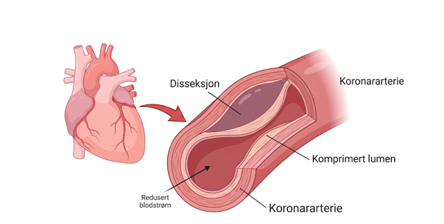 Illustrasjon: Eirunn R&oslash;tnes -Procardio/NOR-SCAD