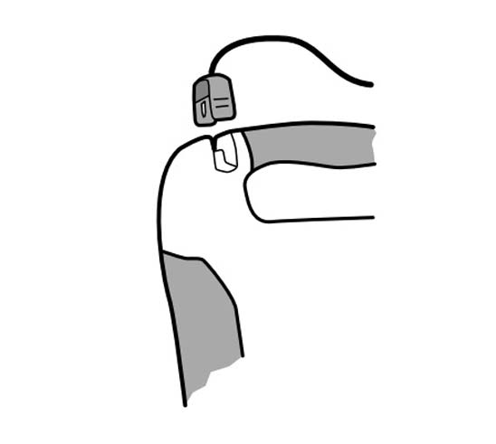 bilde elektrodekontakt p&aring; defibtech AED