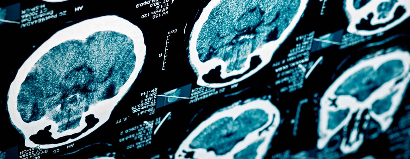 CT-bilde av hjerneslag