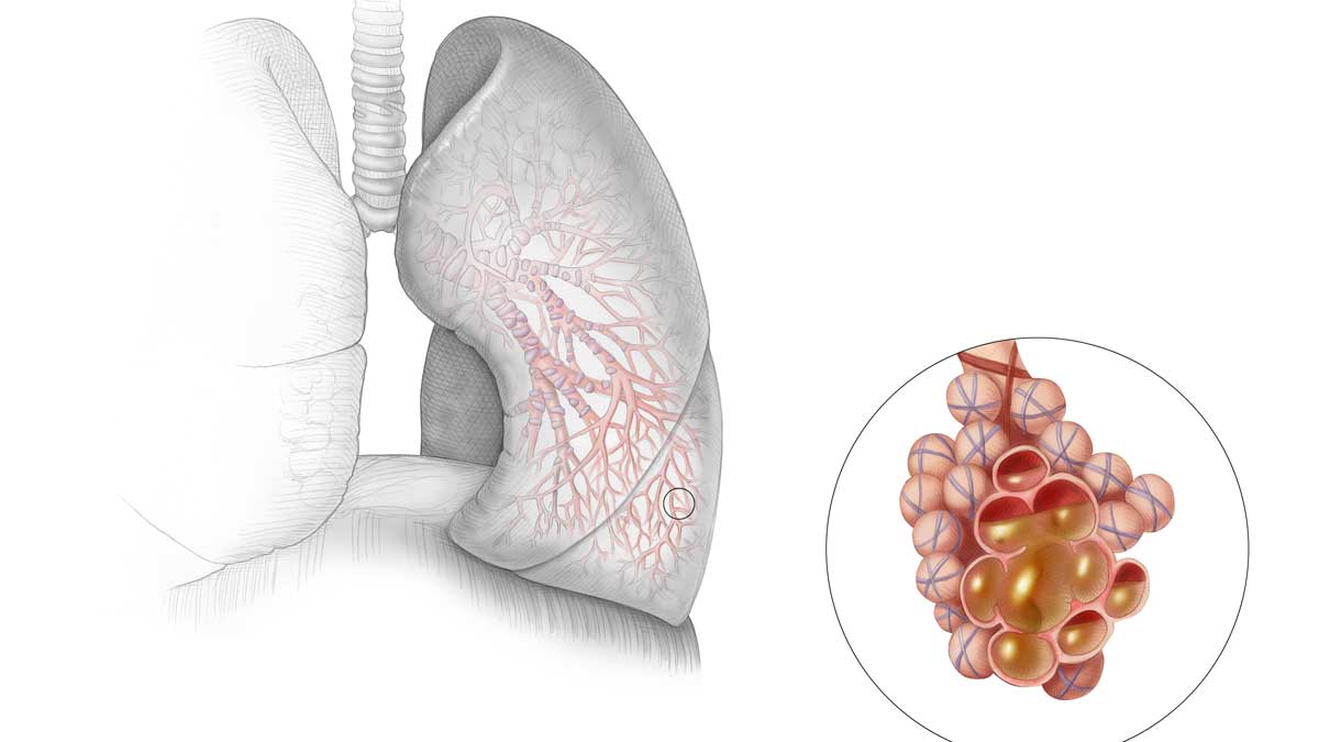 Medisinsk illustrasjon som viser betennelse i lungevevet til et menneske.