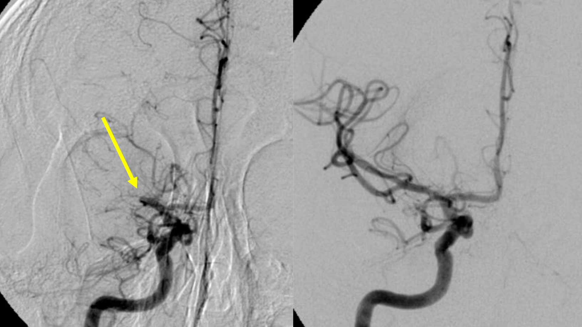 Angiografibilder av intervensjonsbehandling ved hjerneinfarkt.